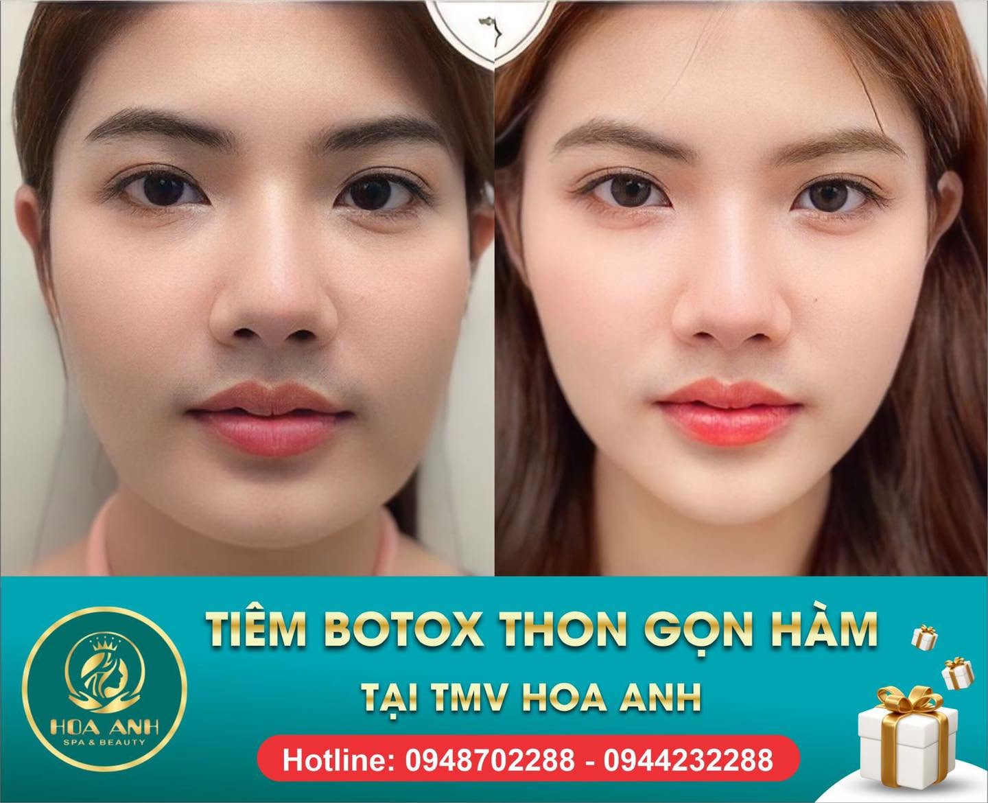 Trước và sau tiêm Botox thon gọn hàm tại Hoa Anh — ca 1